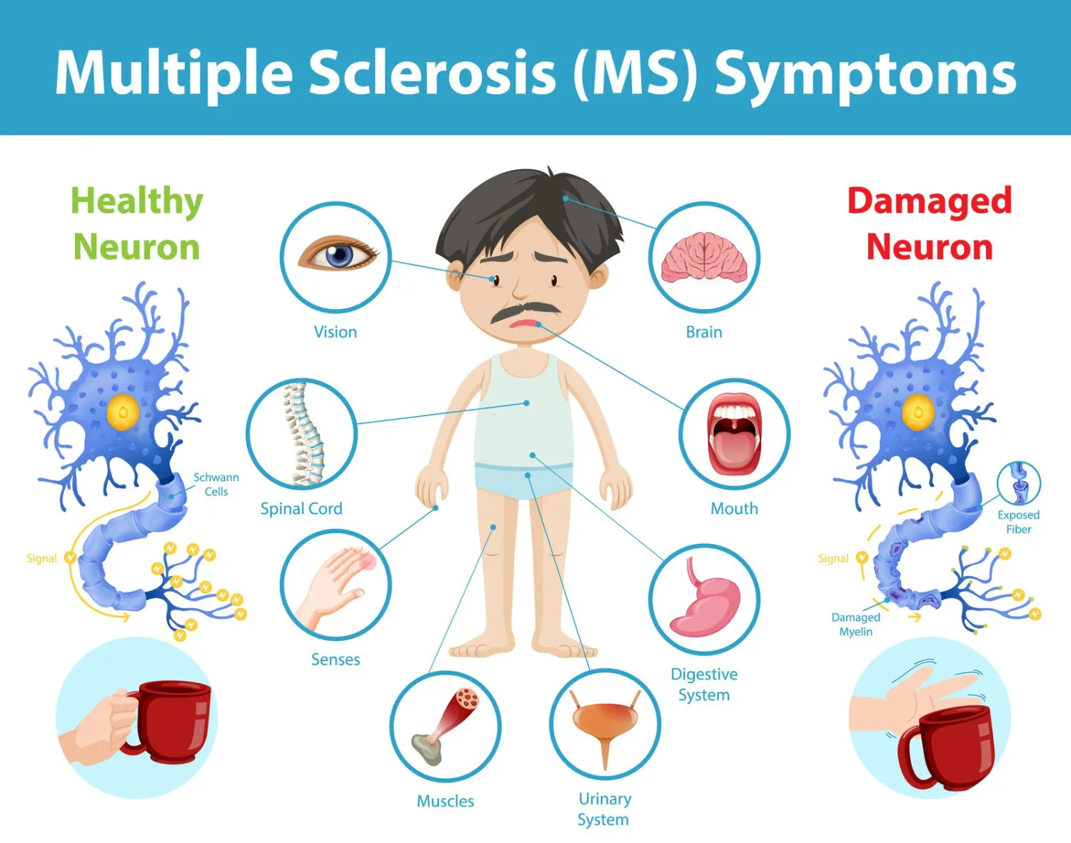 Multiple Sclerosis – Causes, Symptoms and Treatment