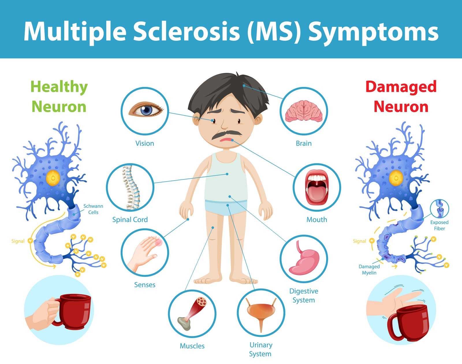 Multiple Sclerosis - Dr. Rohit Gupta