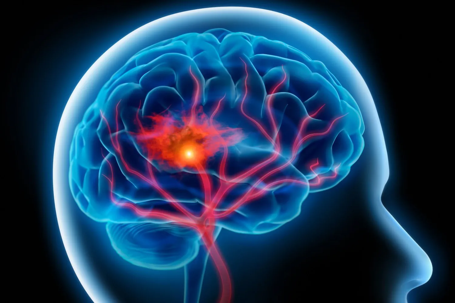 A Short But Essential Guide To Brain Stroke