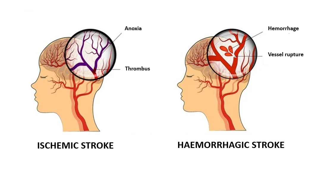 Do You Know That Stroke Is Curable?