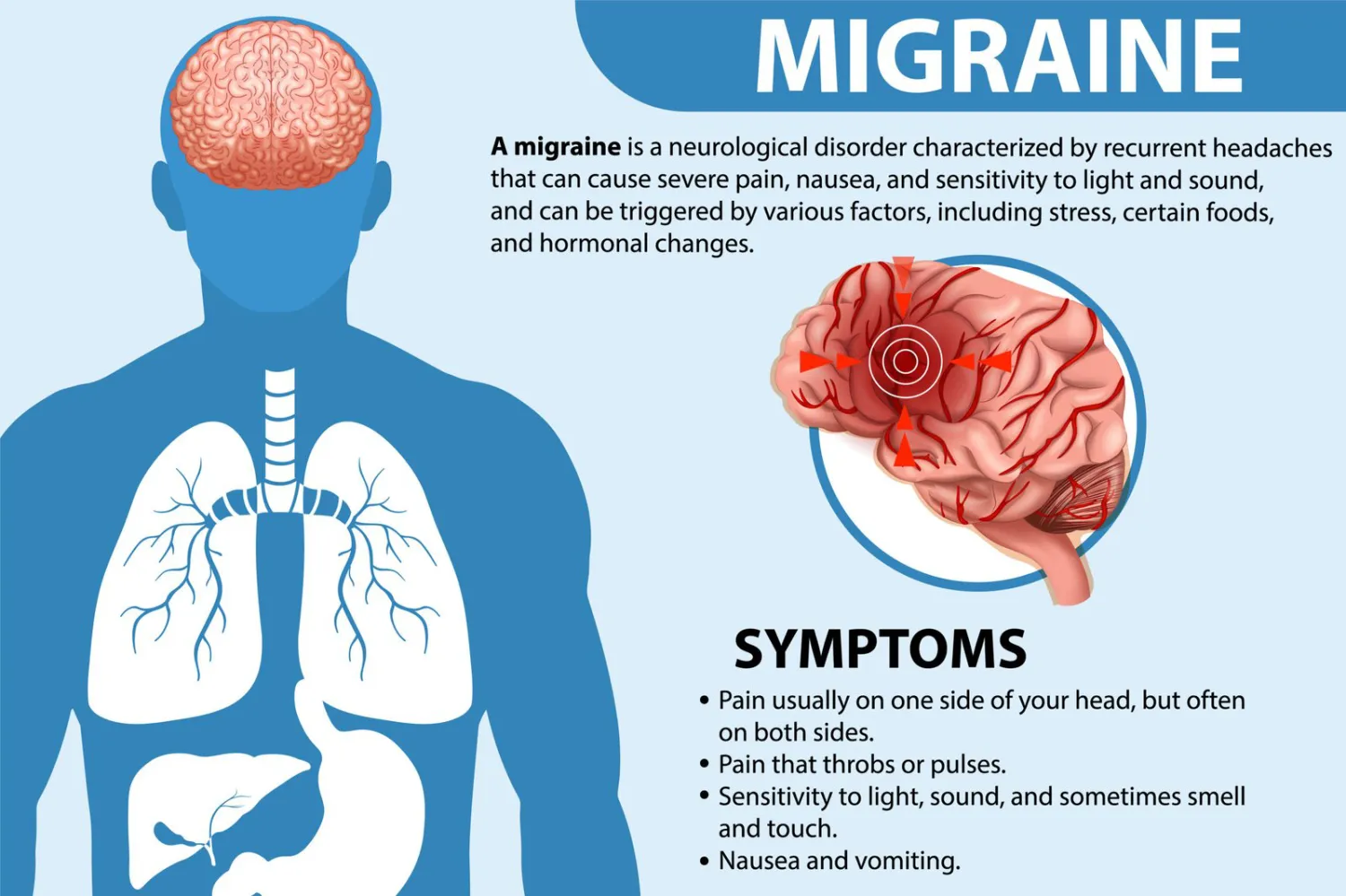 Demystifying Migraines: Causes, Triggers, and Treatment Options