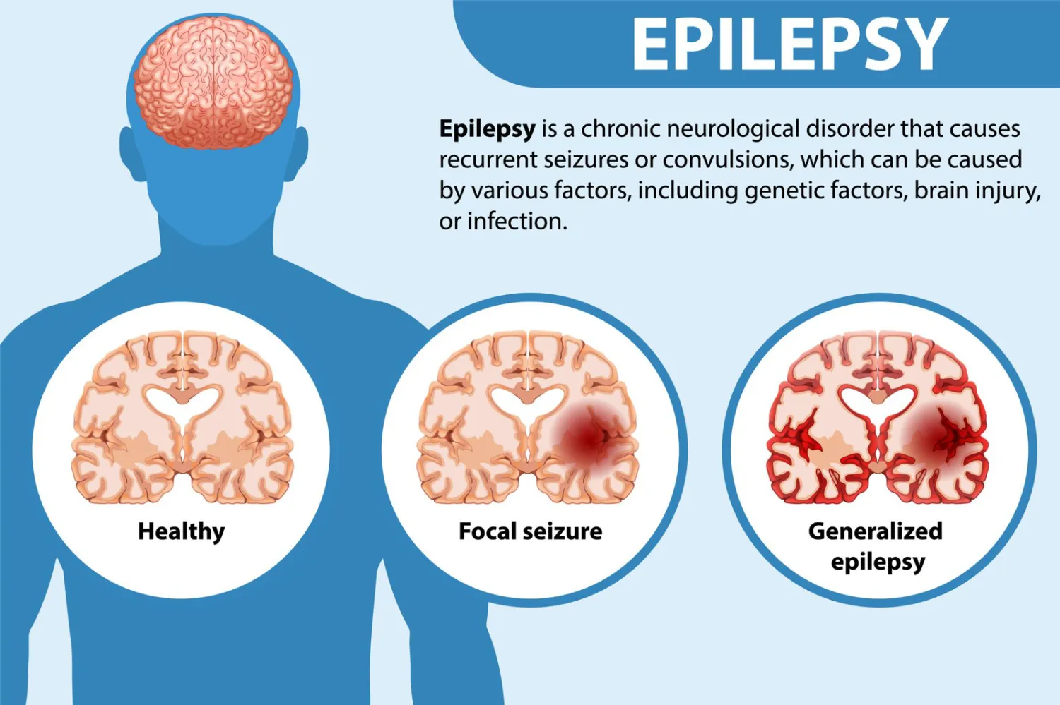 Understanding Epilepsy: Causes, Types, and Treatment Options