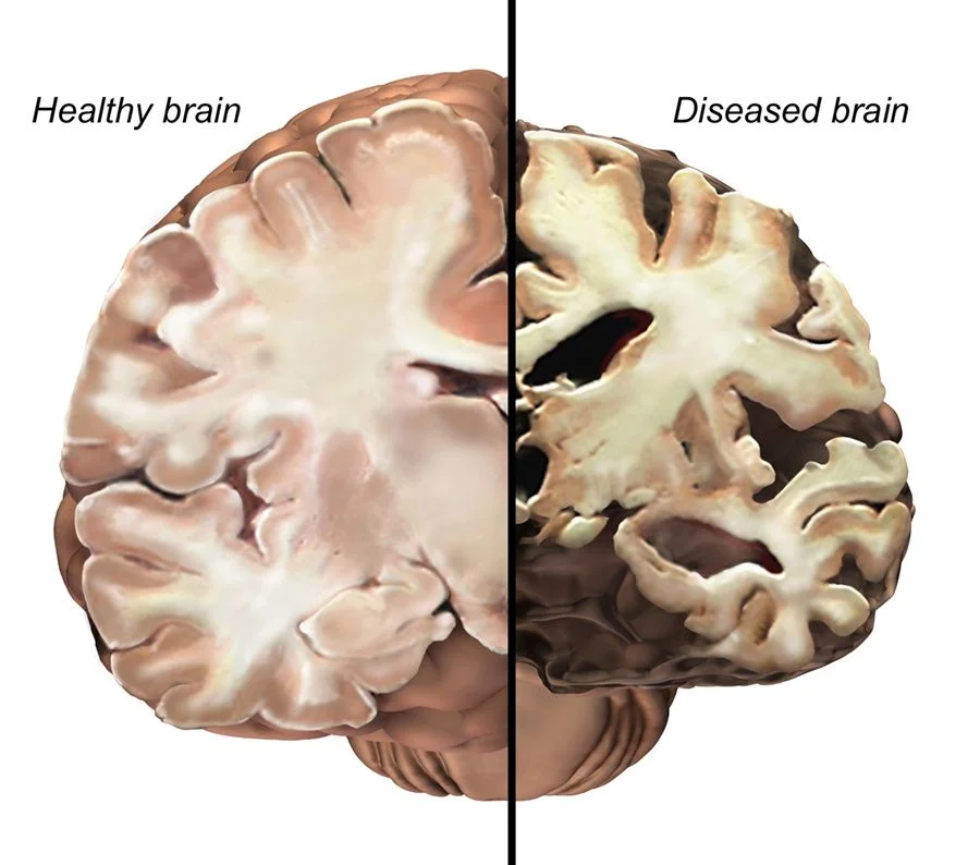 Alzheimer’s Disease