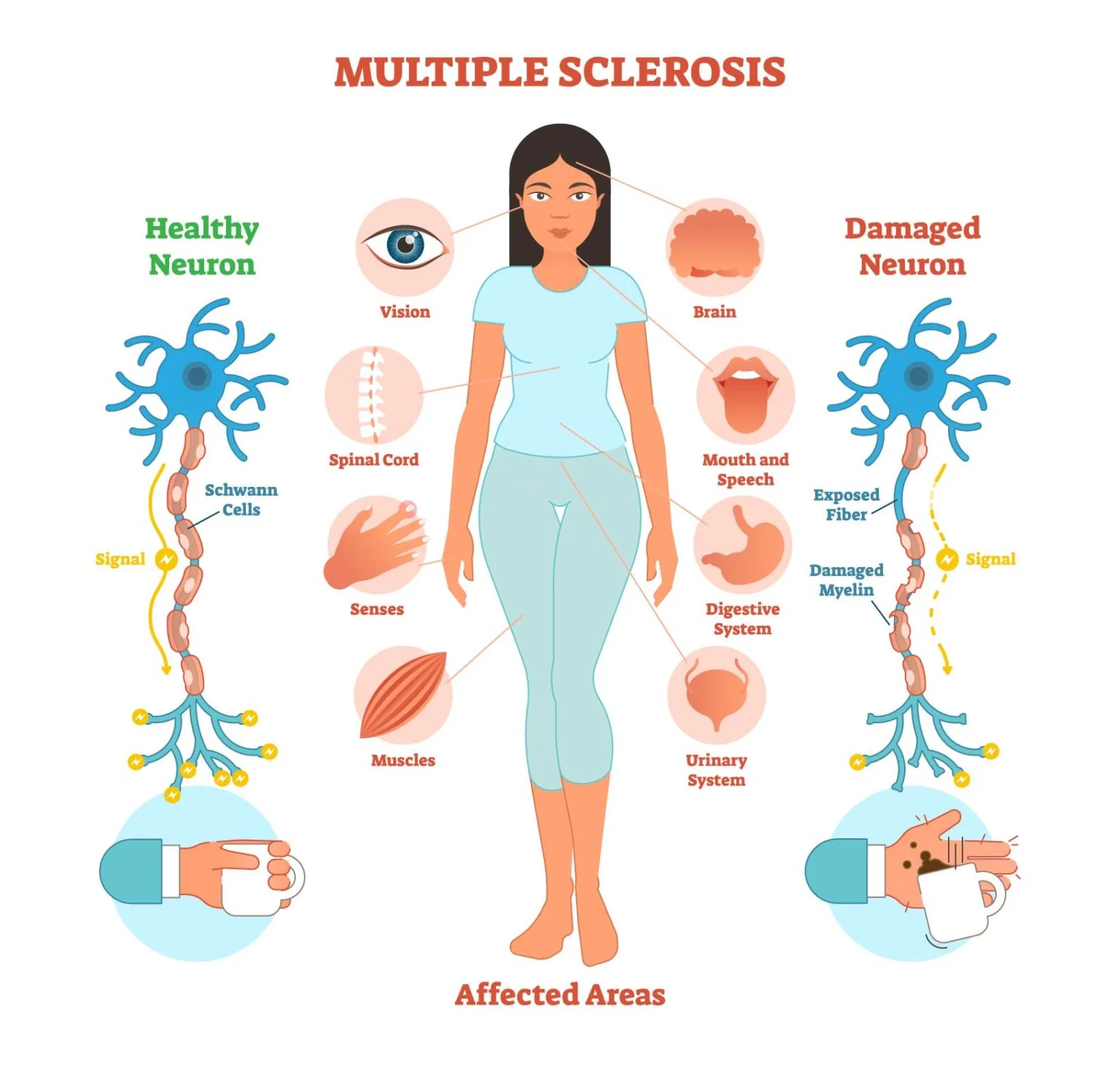 Multiple Sclerosis