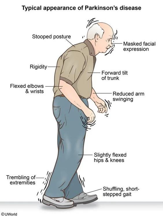 Parkinson’s disease